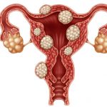Cysts in the ovaries