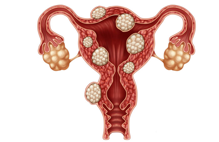 You are currently viewing Cysts in the ovaries