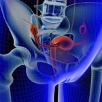Pelvic organ prolapse……Ooops whats falling down