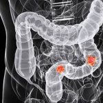 Concerns about colorectal cancer (CRC)