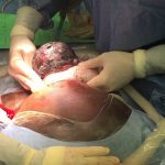 Having a C-section