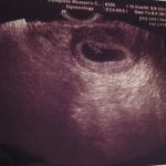 Why some miscarry