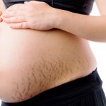 Stretch mark woes