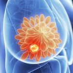 Finding breast cancer genes