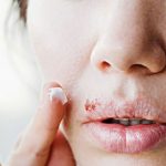 Living With Herpes