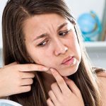 Dealing with acne in your middle age (or older)
