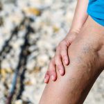 Unsightly varicose veins – is it possible to minimise their appearance?