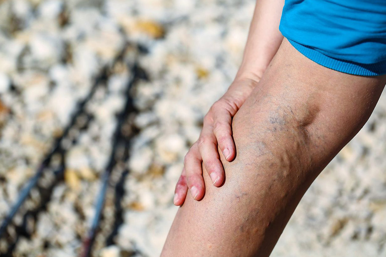 Read more about the article Unsightly varicose veins – is it possible to minimise their appearance?
