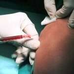 Platelet-rich plasma therapy could help in IVF