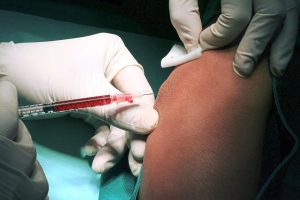 Read more about the article Platelet-rich plasma therapy could help in IVF