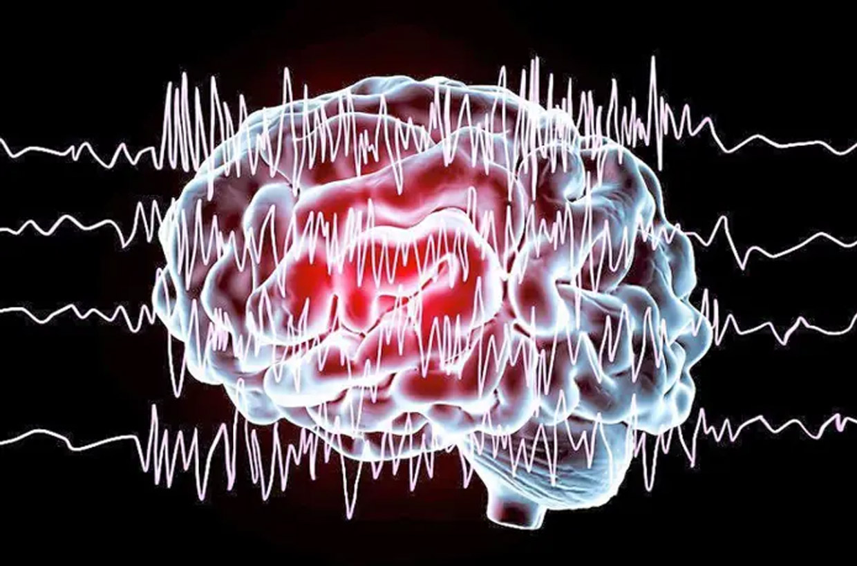 You are currently viewing Taking a functional approach to managing epilepsy